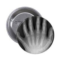 Six mains digitées, rareté médicale, rayon X Badge Avec Épingle
