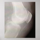 Recherche de genou posters Joint