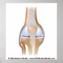 Recherche de articulation art Orthopédique