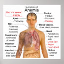 Suche nach anämie poster Diagramm