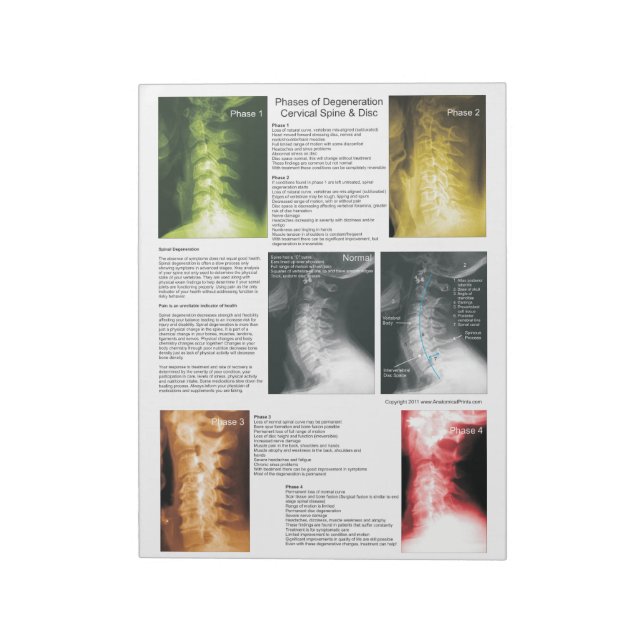 Abreißen von Pad Zervikalspinaldegeneration Notizblock (Rotiert)