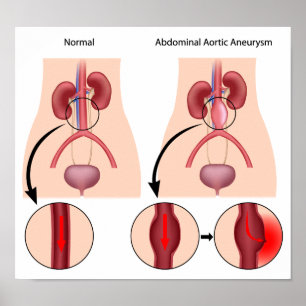 Affiche de l'aortique abdominale