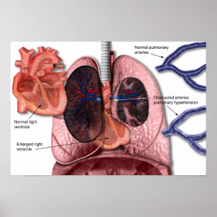 Affiche pulmonaire d'hypertension