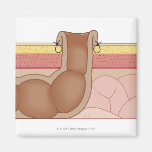 Aimant Colostomie permanente