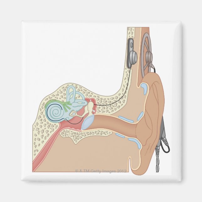 Aimant Implants cochléaires (Devant)