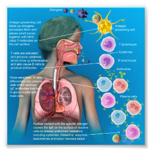 Allergien: IgE entzündliches Warteplakat Fotodruck