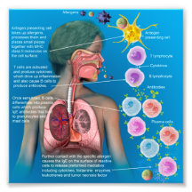 Allergien: IgE-Entzündungsreaktionposter
