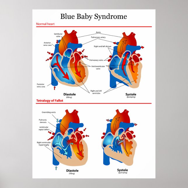 Anatomical Heart Diagram of Blue Baby Syndrome Poster (Vorne)