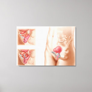 Anatomie des Blasen-Suspendierungs-Verfahrens Leinwanddruck