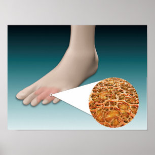 Anatomie des Foot Fungus mit mikroskopischer Nah-u Poster
