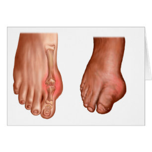 Anatomie D'Un Pied Gonflé