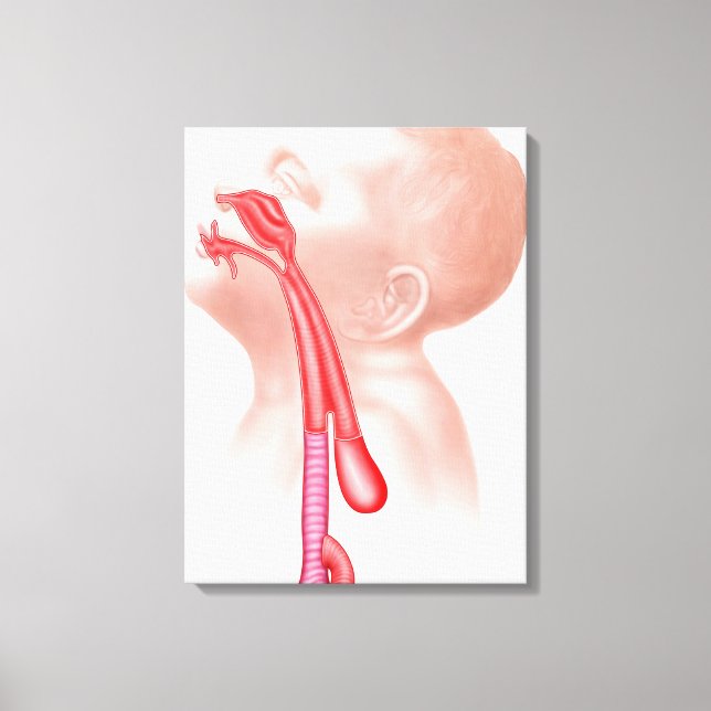 Anatomie einer Tracheesophagealfistula Leinwanddruck (Vorderseite)