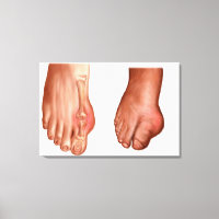 Anatomie eines geschwollenen Fußes