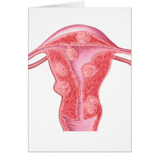 Anatomie fibroider Tumoren bei weiblichen Uterusze