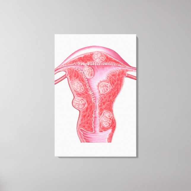 Anatomie fibroider Tumoren bei weiblichen Uterusze Leinwanddruck (Vorderseite)