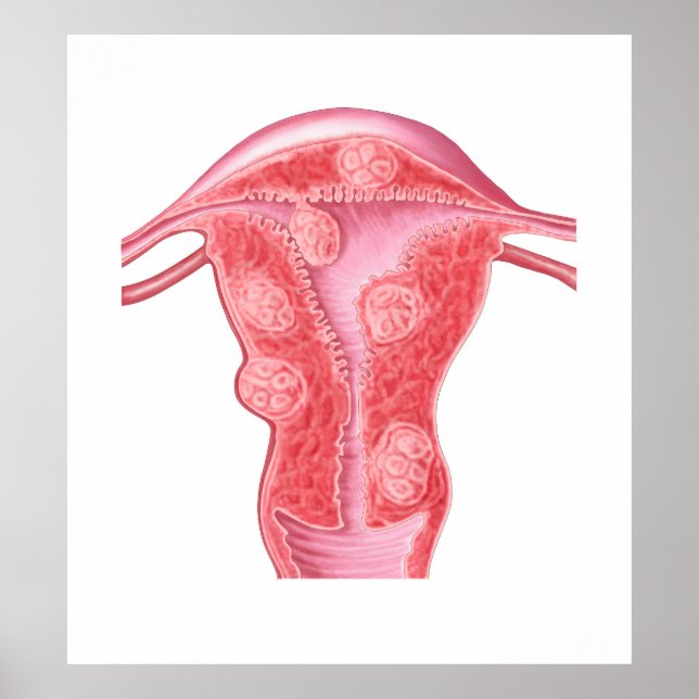 Anatomie fibroider Tumoren bei weiblichen Uterusze Poster (Vorne)