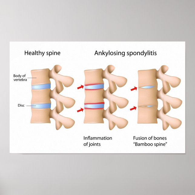 Ankylosierende Spondylitis Poster (Vorne)