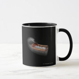 Ansicht eines angioplaty Ballons in einer Arterie Tasse