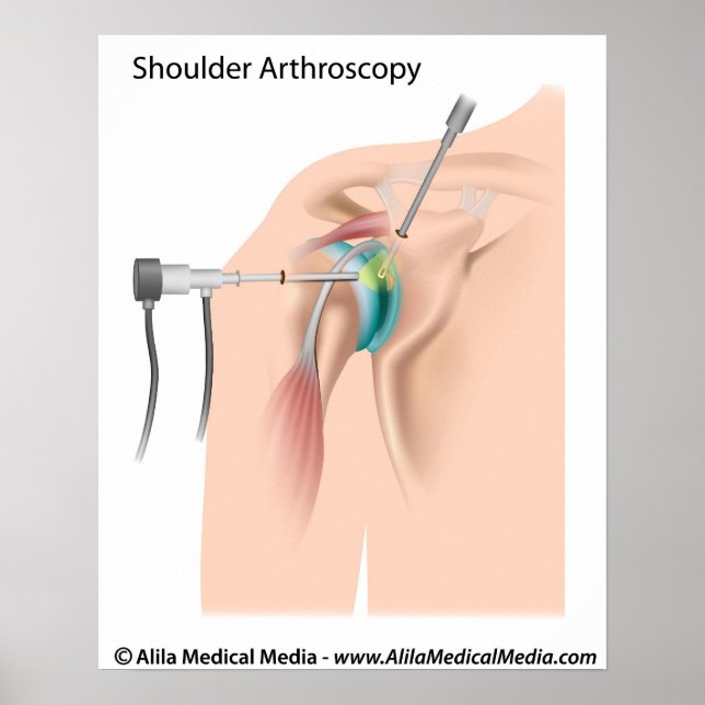 Arthroskopie-Diagramm. Poster (Vorne)