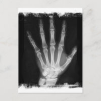B&W Röntgen Skeleton Hand