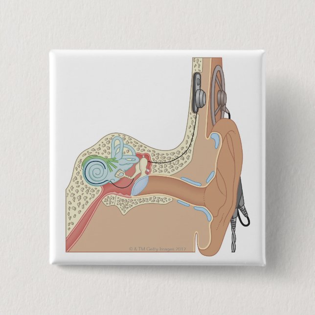 Badge Carré 5 Cm Implants cochléaires (Devant)
