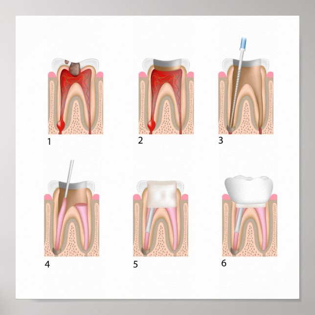 Behandlung des Root Canal Jede Größe Poster (Vorne)