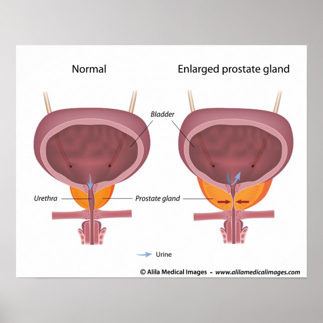 Benigne Prostatahyperplasie, beschriftet. Poster (Vorne)