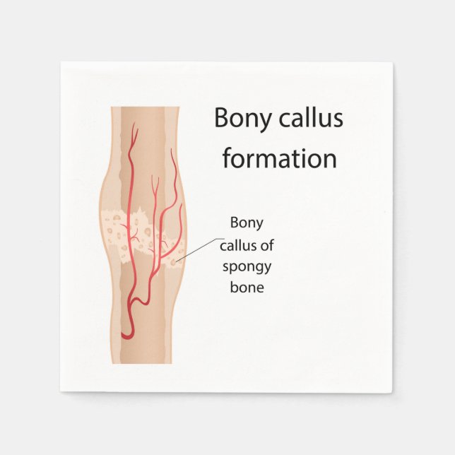 Bildung von Bony callus Serviette (Vorderseite)