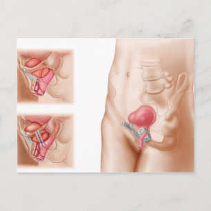 Carte Postale Anatomie De La Procédure De Suspension De Vessie