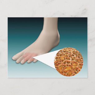 Carte Postale Anatomie Des Fungus Pieds Avec Agrandissement Micr