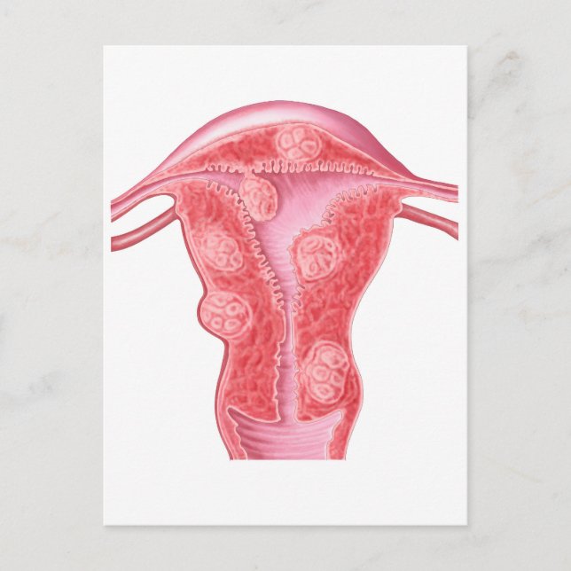 Carte Postale Anatomie Des Tumeurs Fibroïdes Dans L'Utérus Fémin (Devant)