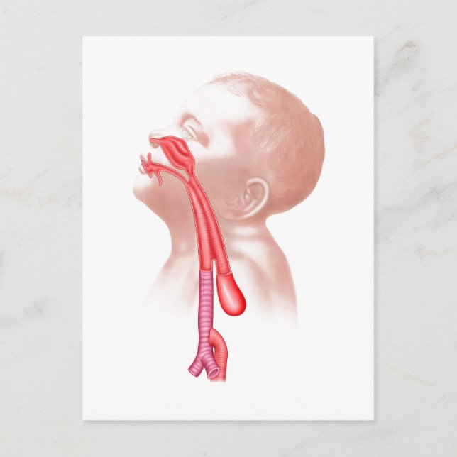 Carte Postale Anatomie D'Une Fistule Trachéesophagienne (Devant)
