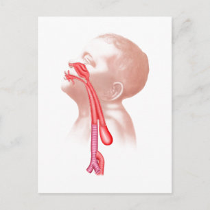 Carte Postale Anatomie D'Une Fistule Trachéesophagienne