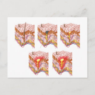 Carte Postale Différents Types D'Acné