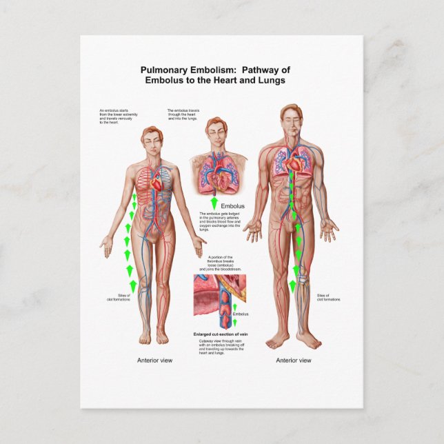 Carte Postale Embolisme Pulmonaire, Voie D'Embolus (Devant)