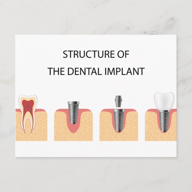 Carte Postale Faire-part Structure de l'implant dentaire (Devant)