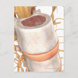 Carte Postale Fermer un disque invertébral dans la colonne verté