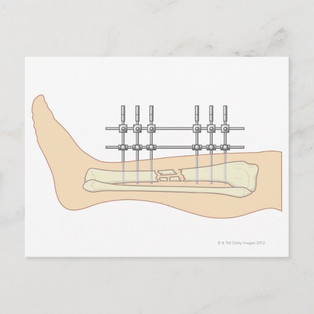 Carte Postale Fixateur externe (Devant)