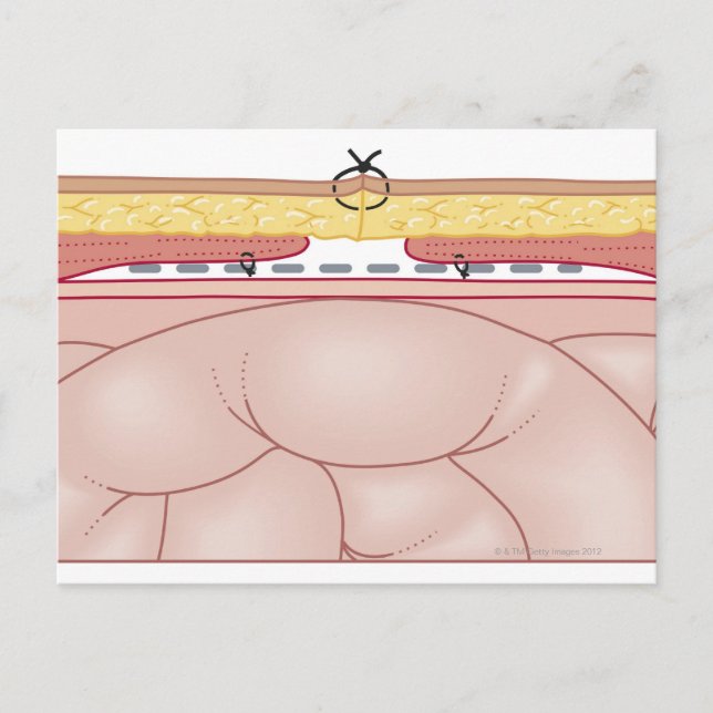 Carte Postale Illustration d'une hernie (Devant)