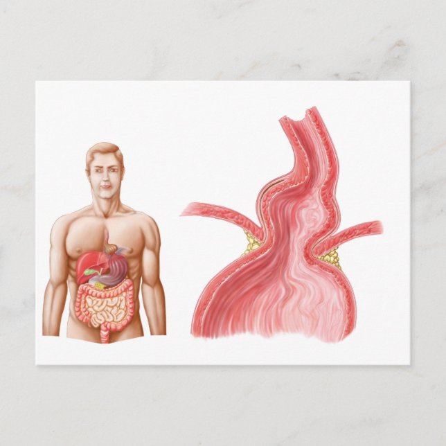 Carte Postale Illustration Médicale D'Une Hernie Hiatal Dans (Devant)