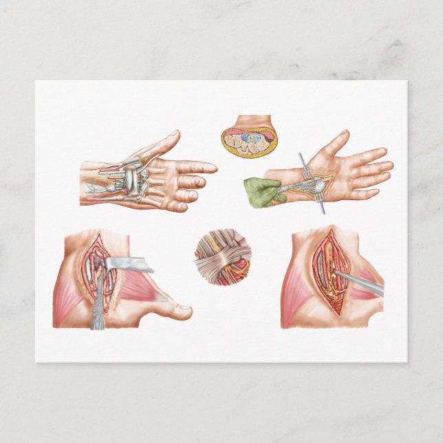 Carte Postale Illustration Médicale montrant le tunnel carpal (Devant)