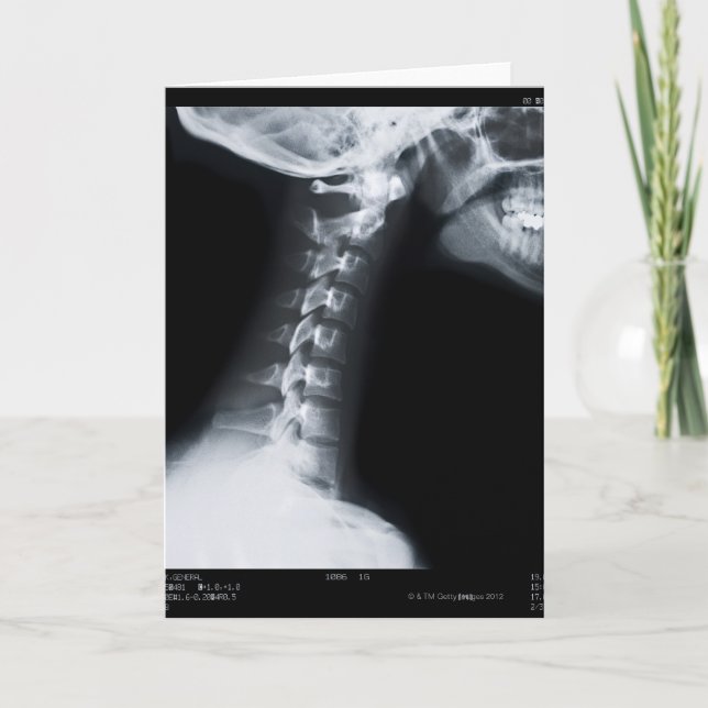 Carte Rayon X des vertèbres de cou comprenant la (Devant)