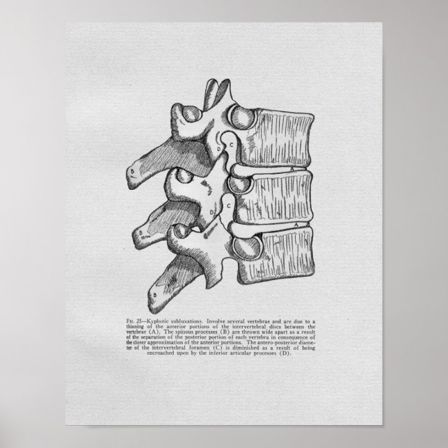 Chiropractic Subluxation Vintag Print Poster (Vorne)