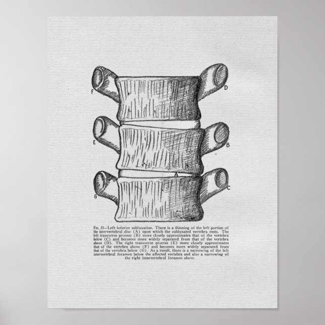 Chiropraktische vertebrale Subluxation Vintag Prin Poster (Vorne)