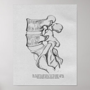 Chiropraktische Wirbelsubluxation Vintage-Druck Poster