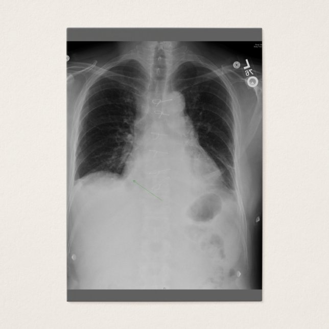 Chirurgie cardiaque ~ ATC (Devant)