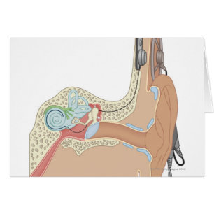 Cochlear- Implantate