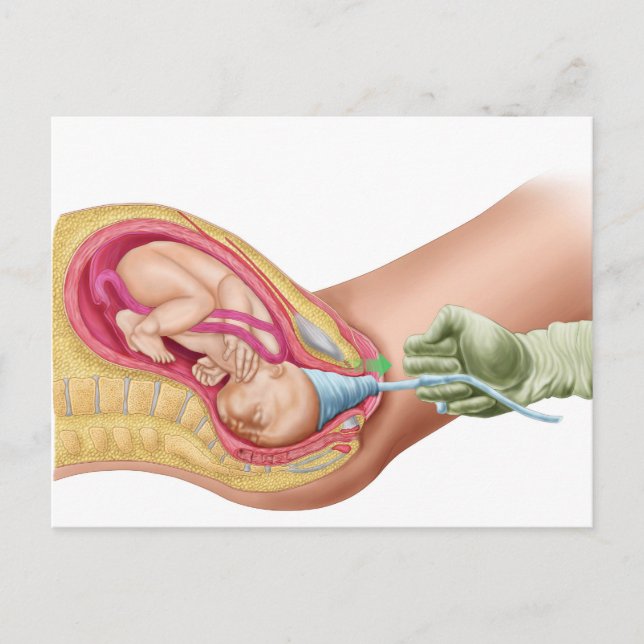 Darstellung der Lieferung von Fetus 1 Postkarte (Vorderseite)