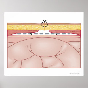 Darstellung einer Hernie Poster