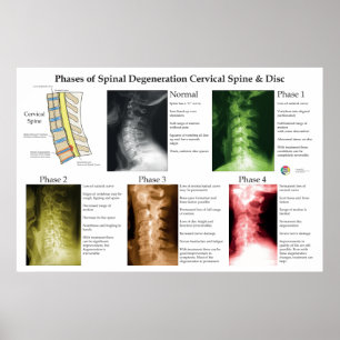 Degeneration der Halswirbelsäule Chiropraktik Poster